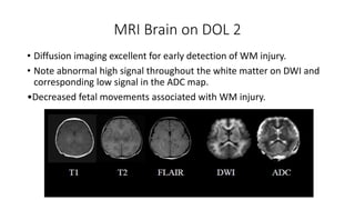 MRI Brain on DOL 2
• Diffusion imaging excellent for early detection of WM injury.
• Note abnormal high signal throughout the white matter on DWI and
corresponding low signal in the ADC map.
•Decreased fetal movements associated with WM injury.
 