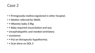 Case 2
• • Primigravida mother,registered in other hospital.
• • Mother referred for MSAF.
• • 40weeks baby 2.9kg
• • Baby required resuscitation and was
• encephalopathic and needed ventilatory
• assistance.
• • Put on therapeutic hypothermia.
• • Scan done on DOL 5
 