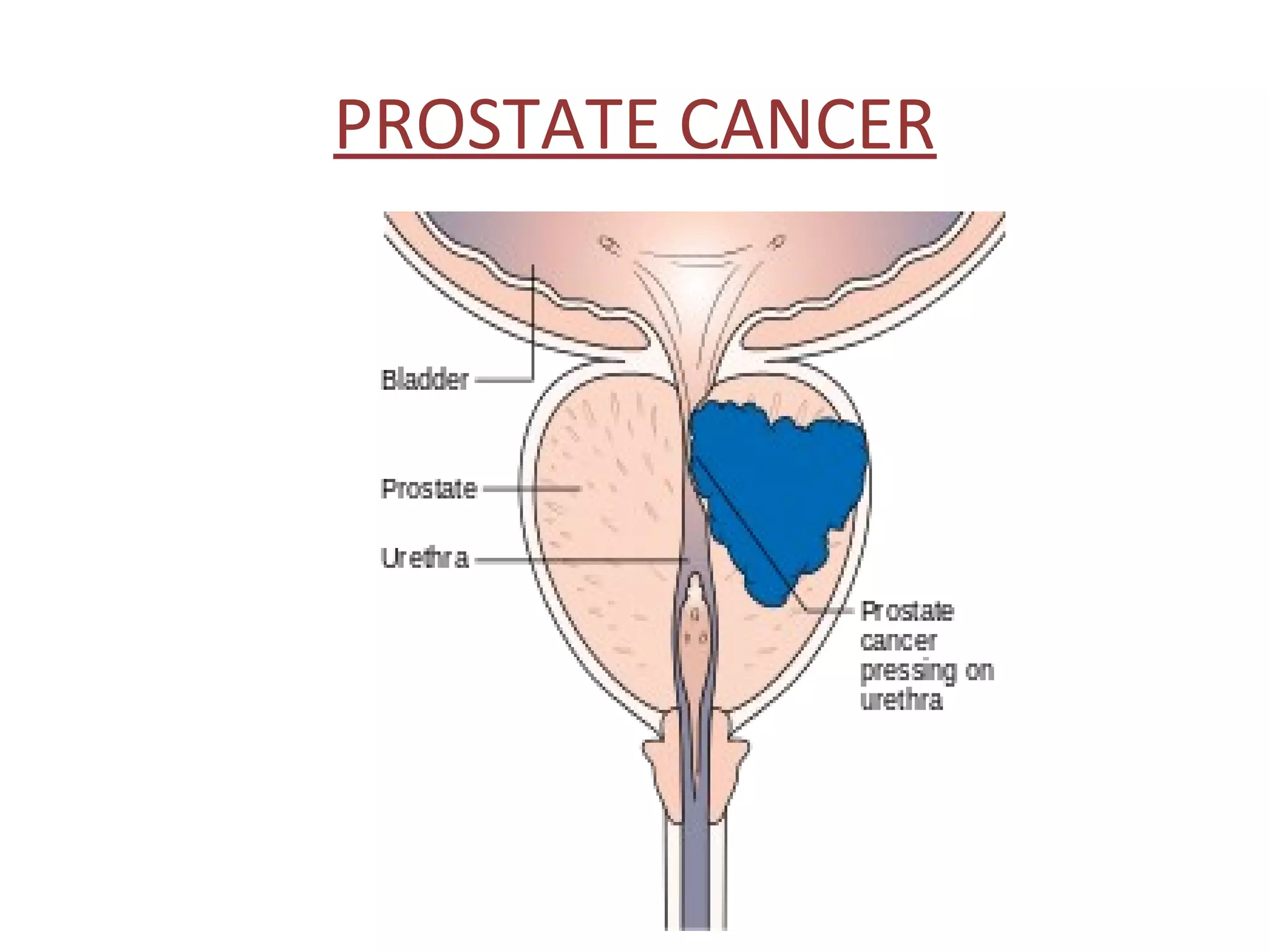 Prostate Chestnut Understanding of prostate cancer | PPT