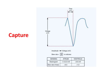Understanding pacemakers | PPTX