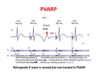 Pvr Pattern Understanding pacemakers | PPTX