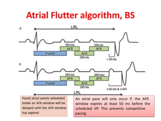 Understanding pacemakers | PPTX