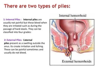 1: Internal Piles : Internal piles are
usually not painful but these bleed when
they are irritated such as during the
passage of hard stools. They can be
classified into four grades:
2: External Piles: External
piles present as a swelling outside the
anus. Its create irritation and itching.
These can be painful sometimes and
usually do not bleed.
 