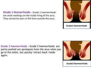 Grade 1 Hemorrhoids : Grade 1 haemorrhoids
are small swellings on the inside lining of the anus.
They cannot be seen or felt from outside the anus.
Grade 2 haemorrhoids : Grade 2 haemorrhoids are
partly pushed out (prolapse) from the anus when you
go to the toilet, but quickly 'retract back' inside
again.
Grade1 Haemorrhoids
Grade2 Haemorrhoids
 