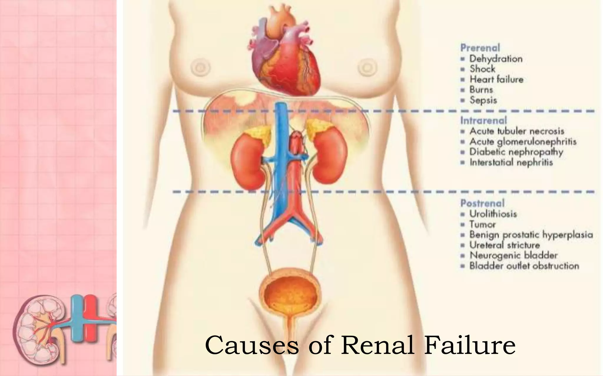 Causes of Renal Failure
 