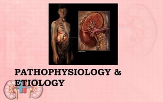 PATHOPHYSIOLOGY &
ETIOLOGY
 