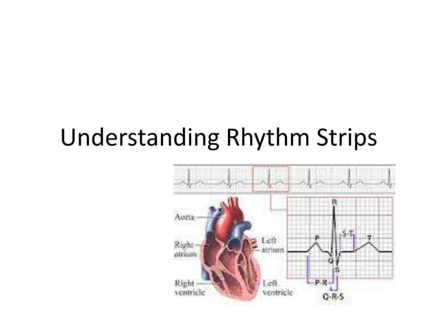 Understanding rhythm strips | PPTX | Heart and Cardiovascular Diseases ...