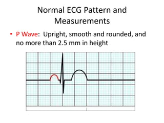 Normal ECG Pattern and
           Measurements
• P Wave: Upright, smooth and rounded, and
  no more than 2.5 mm in height
 