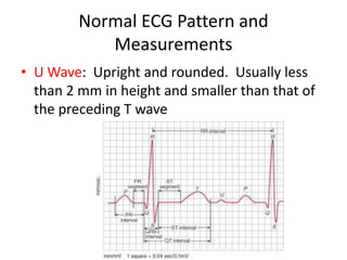 Normal ECG Pattern and
            Measurements
• U Wave: Upright and rounded. Usually less
  than 2 mm in height and smaller than that of
  the preceding T wave
 