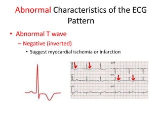 Abnormal Characteristics of the ECG
             Pattern
• Abnormal T wave
  – Negative (inverted)
     • Suggest myocardial ischemia or infarction
 