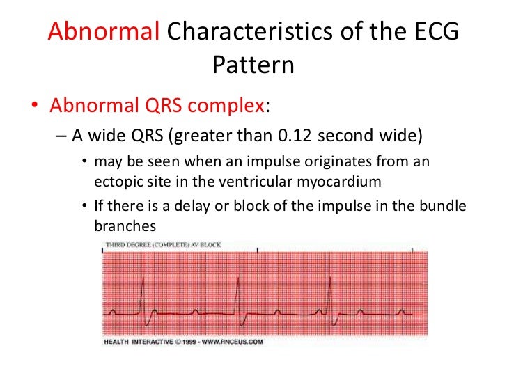 Understanding rhythm strips
