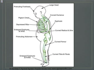 Understanding rickets types,diagnosis,prevention & treatment dr.sandeep ...