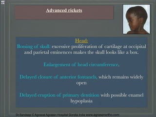 Head In Rickets Understanding rickets types,diagnosis,prevention & treatment dr.sandeep ...