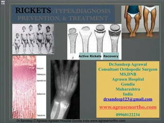 Dr.Sandeep C Agrawal Agrasen Hospital Gondia India www.agrasenortho.com
Dr.Sandeep Agrawal
Consultant Orthopedic Surgeon
MS,DNB
Agrasen Hospital
Gondia
Maharashtra
India
drsandeep123@gmail.com
!
www.agrasenortho.com
!
09960122234
RICKETS :TYPES,DIAGNOSIS
PREVENTION, & TREATMENT
Active Rickets Recovery
 