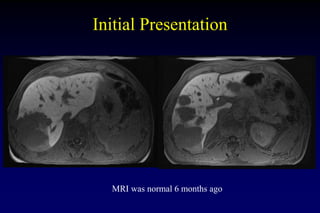 Initial Presentation
MRI was normal 6 months ago
 