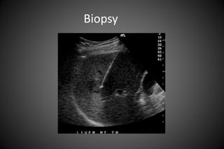 Biopsy
 