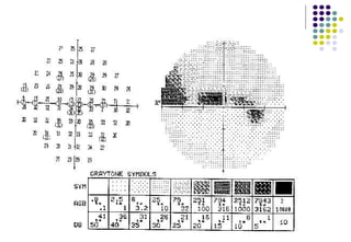 Perimeter Visual Example Understanding the automated perimetry printout in Visual Field.pptx