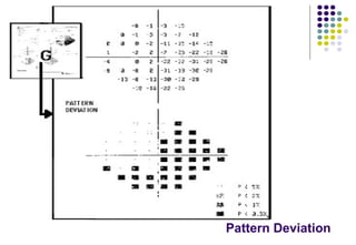 Understanding the automated perimetry printout in Visual Field.pptx