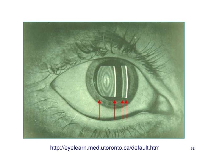 Understanding the slit lamp