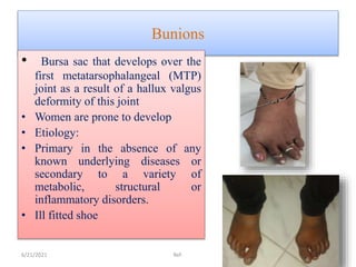 Bunions
• Bursa sac that develops over the
first metatarsophalangeal (MTP)
joint as a result of a hallux valgus
deformity of this joint
• Women are prone to develop
• Etiology:
• Primary in the absence of any
known underlying diseases or
secondary to a variety of
metabolic, structural or
inflammatory disorders.
• Ill fitted shoe
6/21/2021 Ref: 11
 