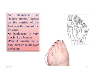 6/21/2021 Ref: 14
•A bunionette, or
"tailor's bunion," occurs
on the outside of the
foot near the base of the
little toe.
•A bunionette is very
much like a bunion.
•Painful bursitis and a
hard corn or callus over
the bump.
 