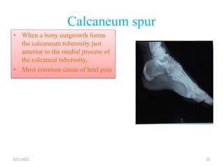 Calcaneum spur
• When a bony outgrowth forms
the calcaneum tuberosity just
anterior to the medial process of
the calcaneal tuberosity,
• Most common cause of heel pain
6/21/2021 23
 