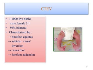CTEV
• 1:1000 live births
• male:female 2:1
• 50% bilateral
• Characterized by :
→ hindfoot equinus
→ subtalar varus/
inversion
→ cavus foot
→ forefoot adduction
34
 