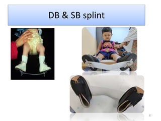 37
DB & SB splint
 