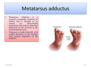 Metatarsus adductus
• Metatarsus Adductus is a
common congenital condition in
infants that is thought to be
caused by intra-uterine
positioning that lead to abnormal
adduction of the forefoot at the
tarsometatarsal joint.
• Diagnosis is made clinically with
medial deviation of the forefoot
with normal alignment of the
hindfoot.
6/21/2021 39
 