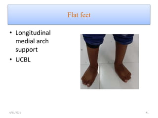 Flat feet
• Longitudinal
medial arch
support
• UCBL
6/21/2021 41
 