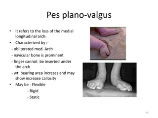 Pes plano-valgus
• It refers to the loss of the medial
longitudinal arch.
• Characterized by :-
- obliterated med. Arch
- navicular bone is prominent
- finger cannot be inserted under
the arch
- wt. bearing area increses and may
show increase callosity
• May be - Flexible
- Rigid
- Static
42
 