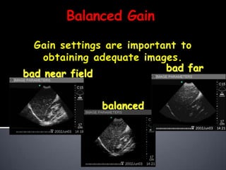 Understanding ultrasound Slide 31