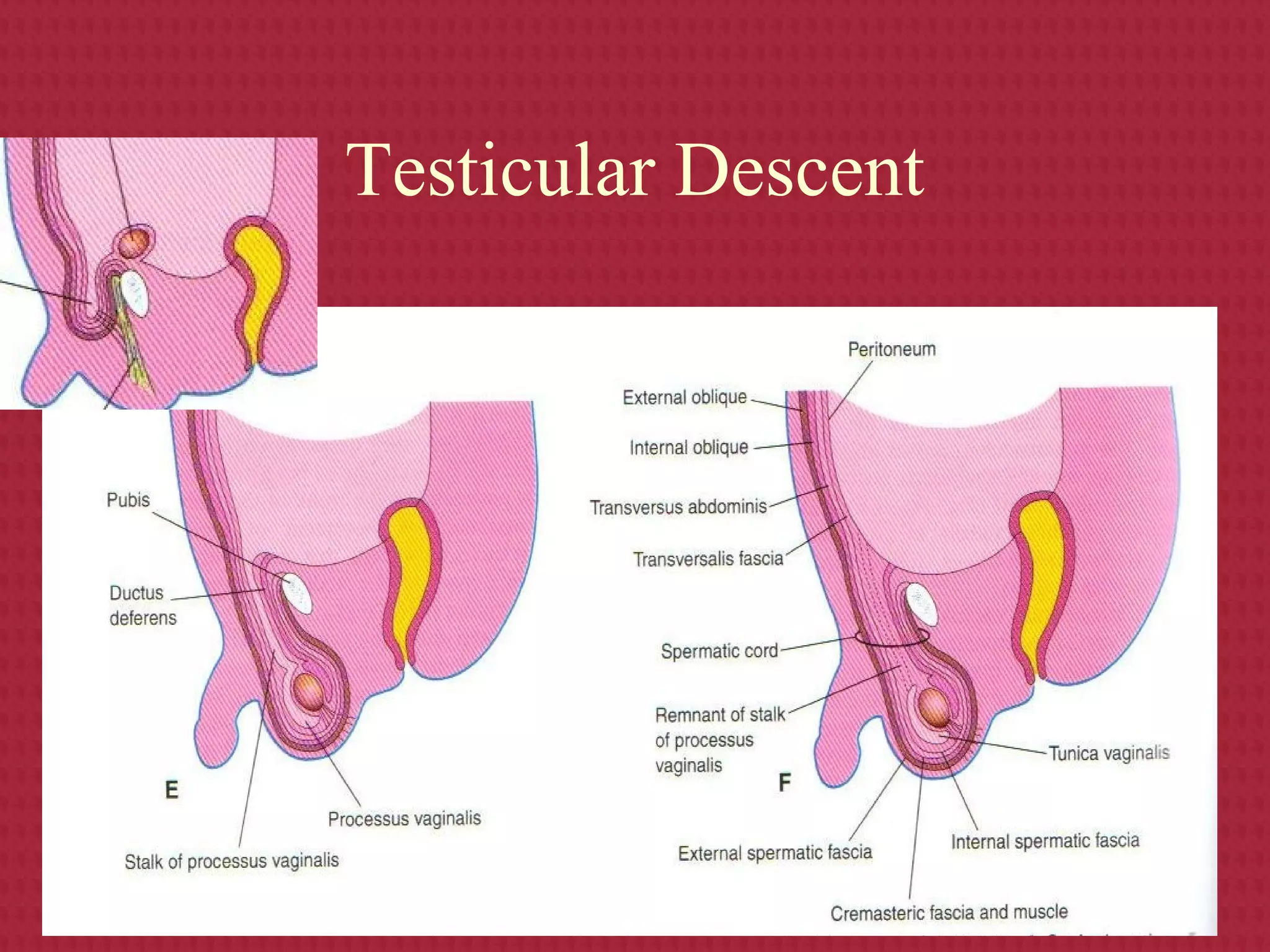 Which Term Best Describes Undescended Testicle S