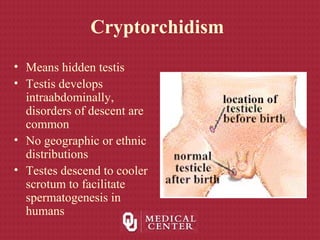 Cryptorchidism
• Means hidden testis
• Testis develops
intraabdominally,
disorders of descent are
common
• No geographic or ethnic
distributions
• Testes descend to cooler
scrotum to facilitate
spermatogenesis in
humans
 