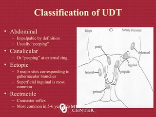 Classification of UDT
• Abdominal
– Impalpable by definition
– Usually “peeping”
• Canalicular
– Or “peeping” at external ring
• Ectopic
– 5 major sites corresponding to
gubernacular branches
– Superficial inguinal is most
common
• Rectractile
– Cremaster reflex
– Most common in 5-6 year olds
 
