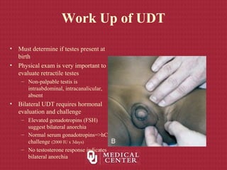 Work Up of UDT
• Must determine if testes present at
birth
• Physical exam is very important to
evaluate retractile testes
– Non-palpable testis is
intraabdominal, intracanalicular,
absent
• Bilateral UDT requires hormonal
evaluation and challenge
– Elevated gonadotropins (FSH)
suggest bilateral anorchia
– Normal serum gonadotropins=>hCG
challenge (2000 IU x 3days)
– No testosterone response indicates
bilateral anorchia
 