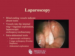 Laparoscopy
• Blind-ending vessels indicate
absent testis
• Vessels into the internal
ring=>inguinal exploration,
laparoscopic
orchiopexy/orchiectomy
• Intra-abdominal testis
– Laparoscopic orchiopexy
– 2 stage orchiopexy (Fowler-
Stephens)
– Abdominal exploration
 