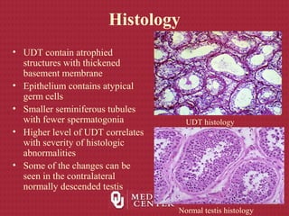 Histology
• UDT contain atrophied
structures with thickened
basement membrane
• Epithelium contains atypical
germ cells
• Smaller seminiferous tubules
with fewer spermatogonia
• Higher level of UDT correlates
with severity of histologic
abnormalities
• Some of the changes can be
seen in the contralateral
normally descended testis
UDT histology
Normal testis histology
 