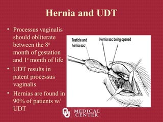 Hernia and UDT
• Processus vaginalis
should obliterate
between the 8th
month of gestation
and 1st
month of life
• UDT results in
patent processus
vaginalis
• Hernias are found in
90% of patients w/
UDT
 