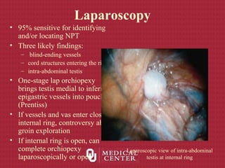 Laparoscopy
• 95% sensitive for identifying
and/or locating NPT
• Three likely findings:
– blind-ending vessels
– cord structures entering the ring
– intra-abdominal testis
• One-stage lap orchiopexy
brings testis medial to inferior
epigastric vessels into pouch
(Prentiss)
• If vessels and vas enter closed
internal ring, controversy about
groin exploration
• If internal ring is open, can
complete orchiopexy
laparoscopically or open
Laparoscopic view of intra-abdominal
testis at internal ring
 
