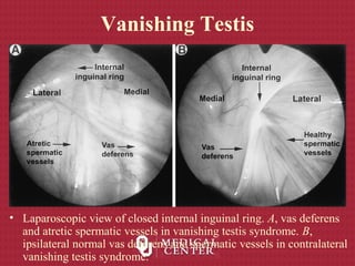 Vanishing Testis
• Laparoscopic view of closed internal inguinal ring. A, vas deferens
and atretic spermatic vessels in vanishing testis syndrome. B,
ipsilateral normal vas deferens and spermatic vessels in contralateral
vanishing testis syndrome.
 