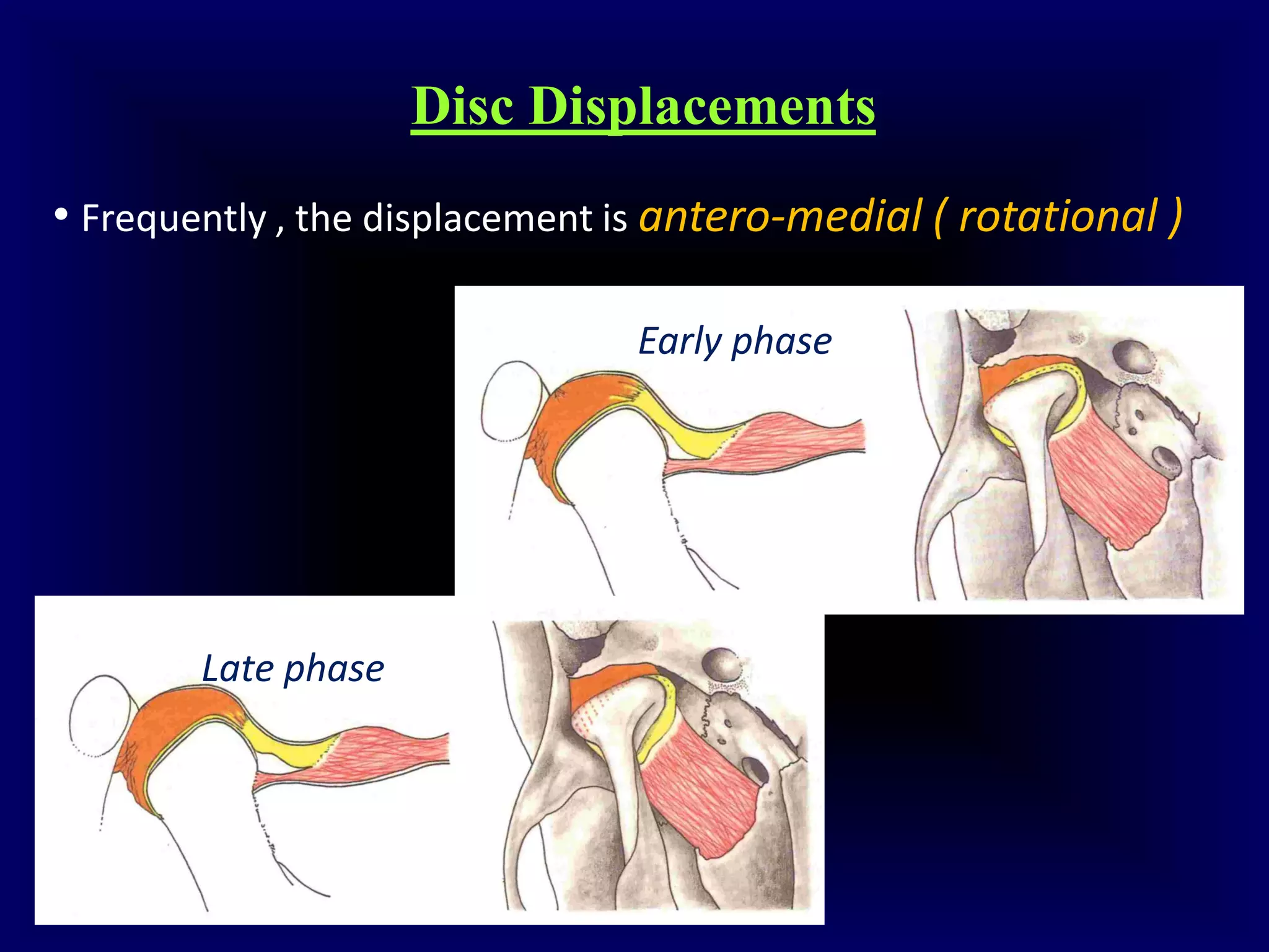 Tmj Deviation Deflection Undestanding tmj internal derangements 1 | PDF