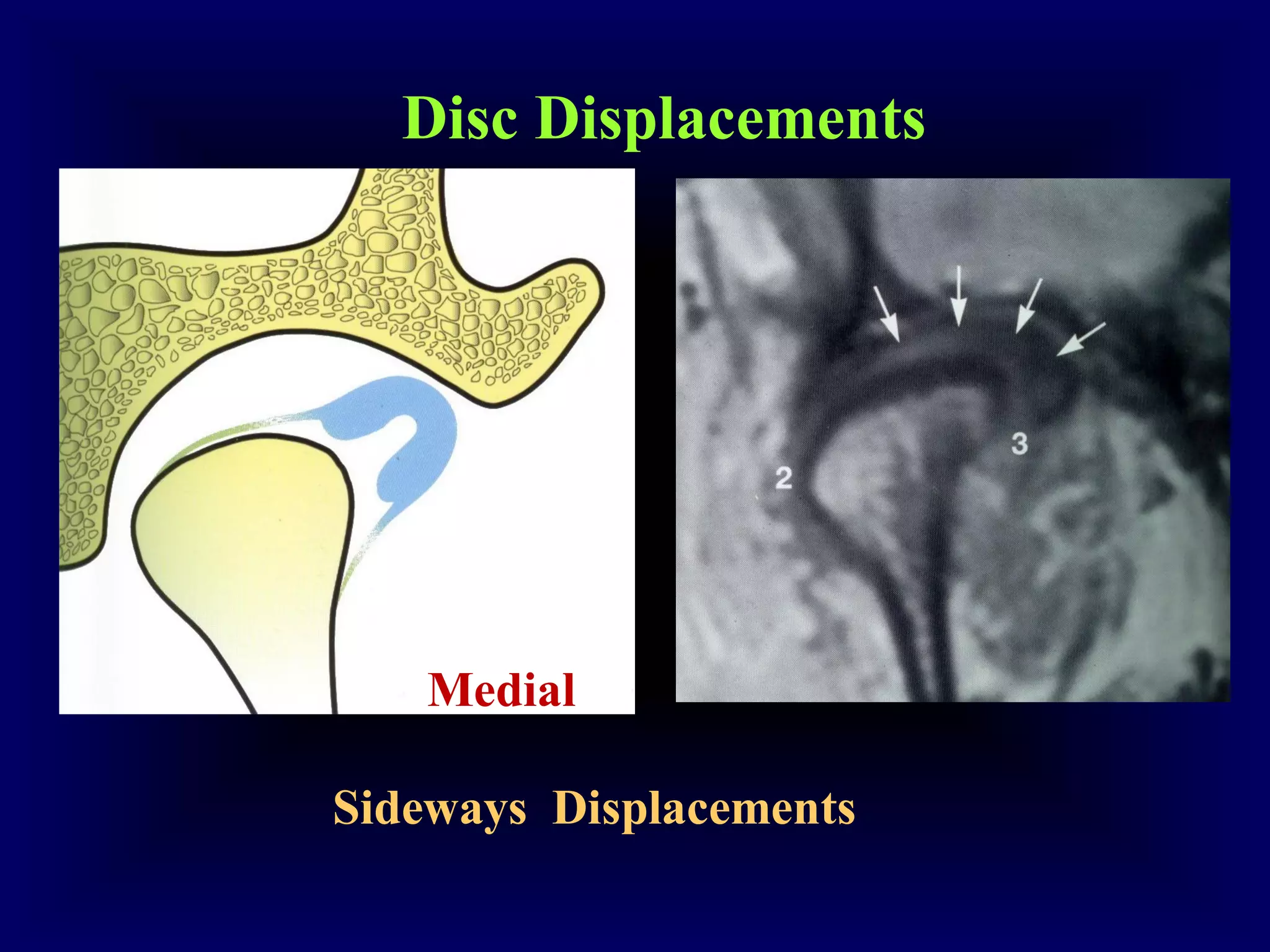 Undestanding tmj internal derangements 1 PDF