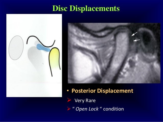 Undestanding tmj internal derangements 1