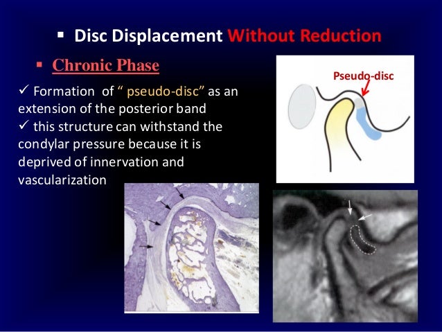 Listhesis treatment picture