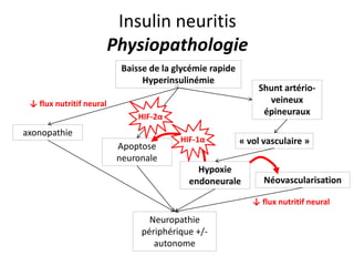 Insulin neuritis
Physiopathologie
Baisse de la glycémie rapide
Hyperinsulinémie
axonopathie
Apoptose
neuronale
Shunt artério-
veineux
épineuraux
Hypoxie
endoneurale
« vol vasculaire »
Néovascularisation
Neuropathie
périphérique +/-
autonome
HIF-1α
HIF-2α
↓ flux nutritif neural
↓ flux nutritif neural
 