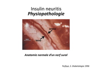 Insulin neuritis
Physiopathologie
Anatomie normale d’un nerf sural
Veine
Artère
Tesfaye, S. Diabetologia 1996
 