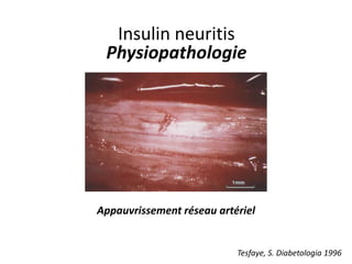 Insulin neuritis
Physiopathologie
Appauvrissement réseau artériel
Tesfaye, S. Diabetologia 1996
 