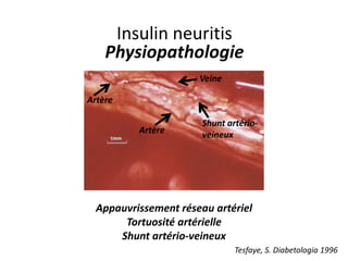 Insulin neuritis
Physiopathologie
Artère
Artère
Veine
Shunt artério-
veineux
Appauvrissement réseau artériel
Tortuosité artérielle
Shunt artério-veineux
Tesfaye, S. Diabetologia 1996
 