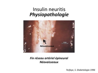 Insulin neuritis
Physiopathologie
Fin réseau artériel épineural
Néovaisseaux
Néovaisseaux
Tesfaye, S. Diabetologia 1996
 